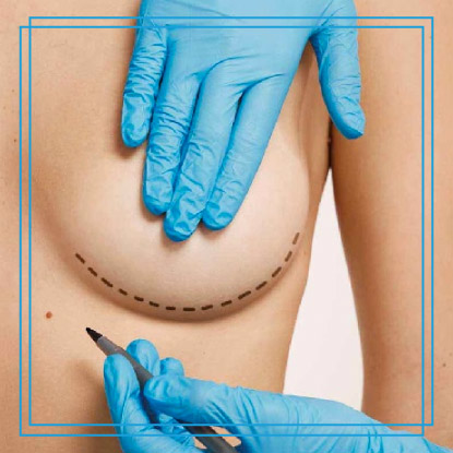 Dr-Paul-Silvers-cirujano-plastico-quito-cirugia-de-Levantamiento-Mamario-Mastopexia-en-quito